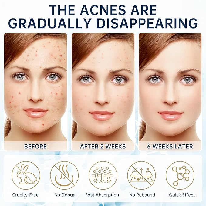 14% Azelaic Acid Acne Cream, 2PCS Azelaic Acid Serum with Hyaluronic Acid, Niacinamide & Squalane, Reduce Acne, Pore Refining & Oil Control, Face Moisturizer for All Skin Types