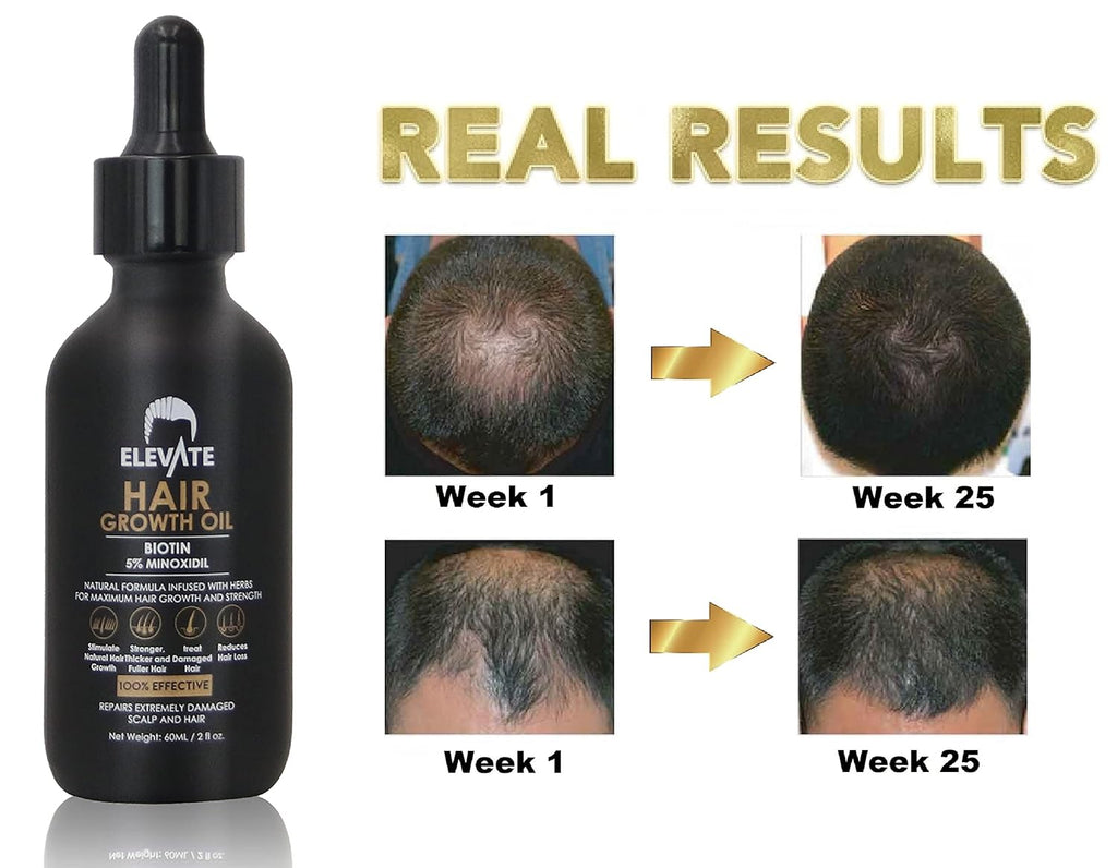 Elevate Hair Regrowth Treatment 5% Minoxidil Solution – Biotin Serum Hair Growth Oil for Men & Women - Thicker Fuller Stronger Hair - Stops Hair Loss & Thinning - Natural Hair Thickening Treatment 2oz