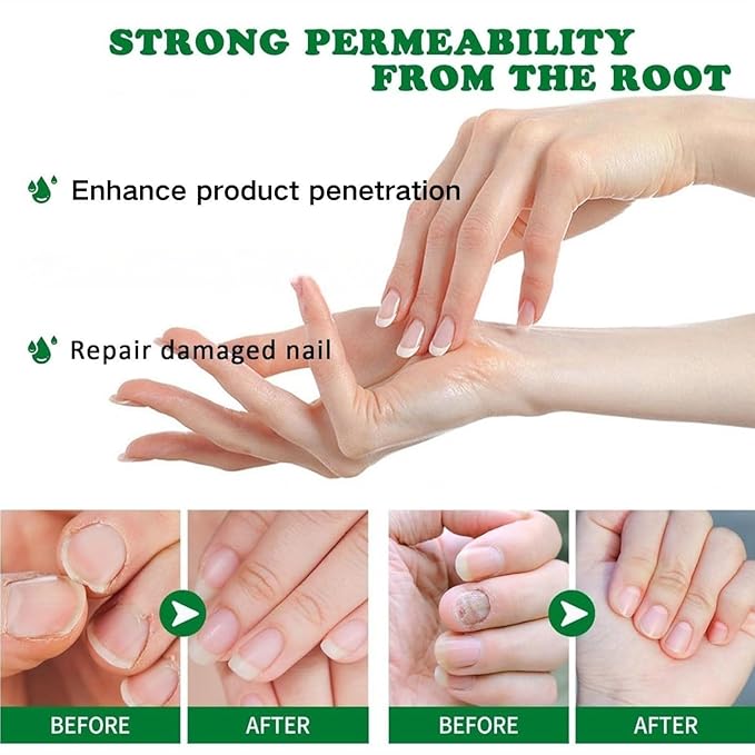 2PCS Ginger Nail Treatment, Ginger Cuticle Care Oil for Nails, Multi-Purpose Nail Repair Nutrient Oil (01)