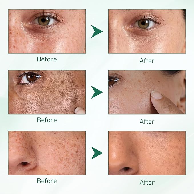 2Pcs Upgraded Anti-𝐟𝐫𝐞𝐜𝐤𝐥𝐞 Essence Oil, 577 𝐒𝐩𝐨𝐭 Remover Serum, Yuxintang Facial Spray, 577 Spray for Face, Body