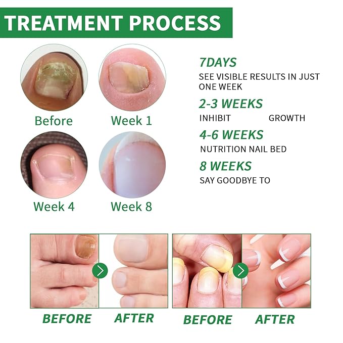 2PCS Ginger Nail Treatment, Ginger Cuticle Care Oil for Nails, Multi-Purpose Nail Repair Nutrient Oil (01)