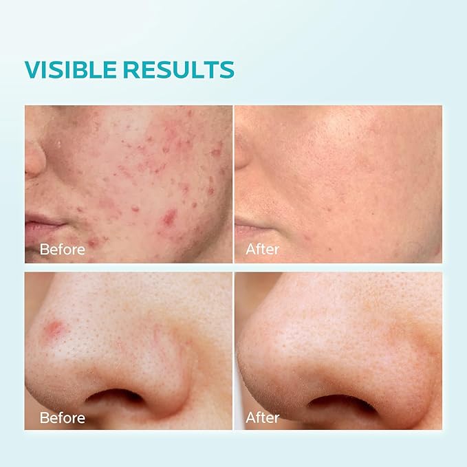 ZealSea 10% Azelaic Acid Facial Cream - Azelaic Acid Serum with AHA & Pionin for Face, Relief Pimple, Breakouts, Blackhead & Redness, Azelaic Acid Gel Clarify Skin Soothe Irritation, 1 Oz