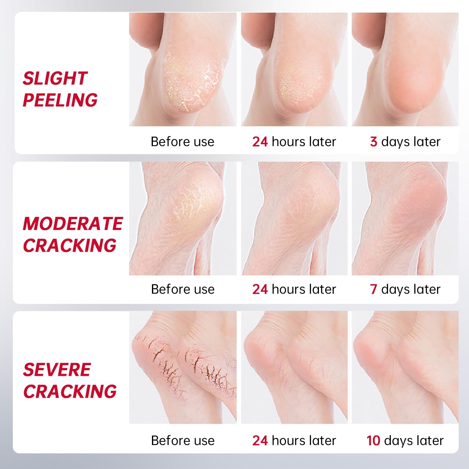 Urea Cream 40 Percent for Feet Maximum Strength, with Heel Protectors, Foot Moisturizer Cream for Dry Cracked Heels Rough Dead Dry Skin Foot Callus Remover - 5.29 Oz