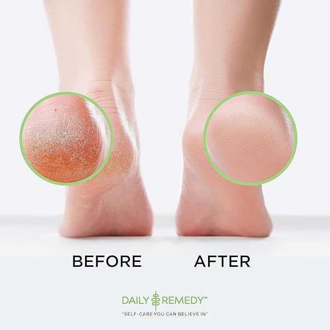 Foot Callus Remover Gel Set - Professional Callus Remover for Feet, Calloused Feet Remover Gel - Pedicure Kit & Foot Spa Tools - Feet Callus Remover - 8oz w/ 16oz Tea Tree Oil Foot Soak - USA