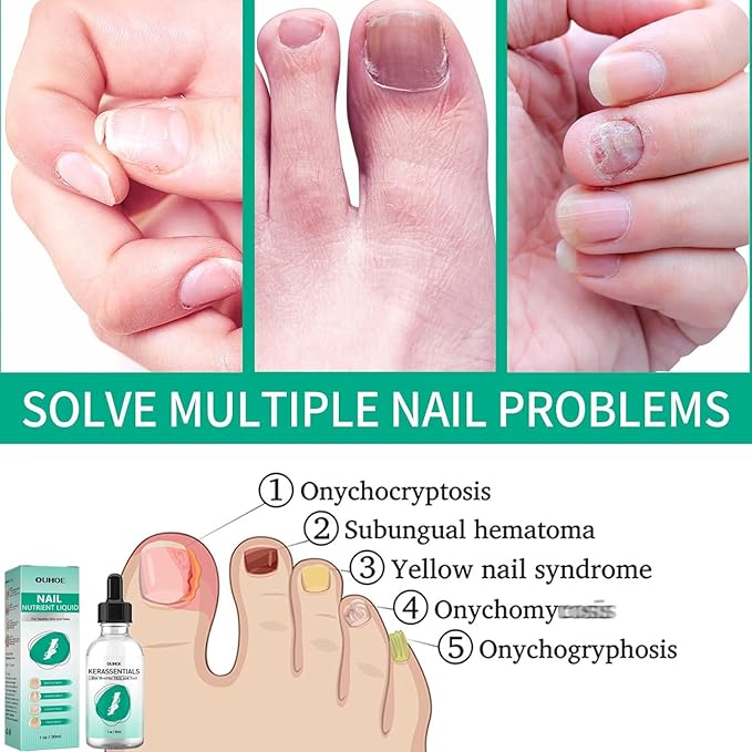 Kerassentials Toenail Oil, Kerassentials Nails Nutrient Oil, Nail Repair Solution 30ML/1PCS (4PCS)