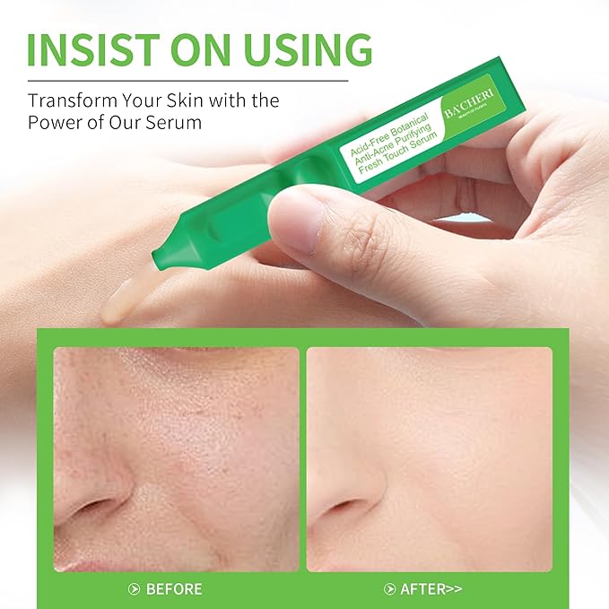 Acid-Free Botanical Anti-Acne Serum, Soothing Hydrates And Promotes Skin Healing Calms irritation and inflammation With Willow Bark, Lavender, Gardenia Extracts