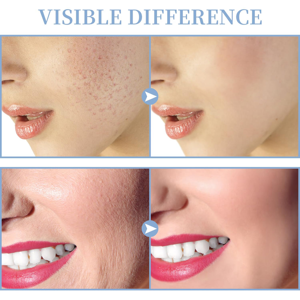 High Frequency Facial Machine - TUMAKOU Portable Handheld High Frequency Facial Skin Wand Machine with 4 Different Tubes