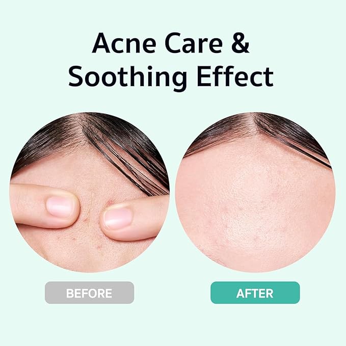 BRING GREEN X NETFLIX SQUID GAME Edition Zinc Teca Serum 25mL | Calming Serum for Skin Soothing & Oil Control | Includes Free Gonggi Tossing Game as Seen in Squid Game