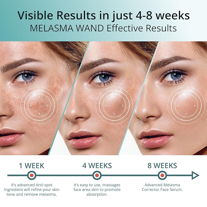 Abera Melasma Serum with Niacinamide and Hyaluronic Acid, Dark Spot Corrector Serum, Melasma Treatment for Face, Suitable for All Skin Types, 0.68 fl. Oz, Set of 3