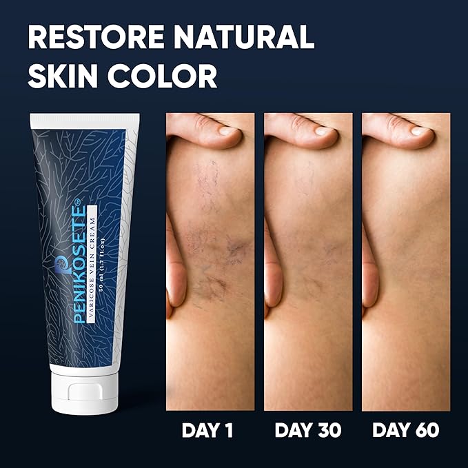 Advanced Vein Care Kit of America's 1st Ashwagandha Cream & Reduce Varicose Veins & Boost Circulation with 60 Easy-to-Swallow Ayurvedic Tablets of Ashwagandha, Punarnava, Turmeric & Triphala