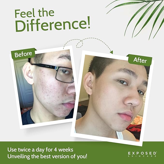 Exposed Skin Care Expanded Acne Treatment Kit - Includes Salicylic Acid Face Wash, Clearing Tonic, Treatment Serum with Benzoyl Peroxide, Clear Pore Serum, Moisture Complex - Made for All Skin Types