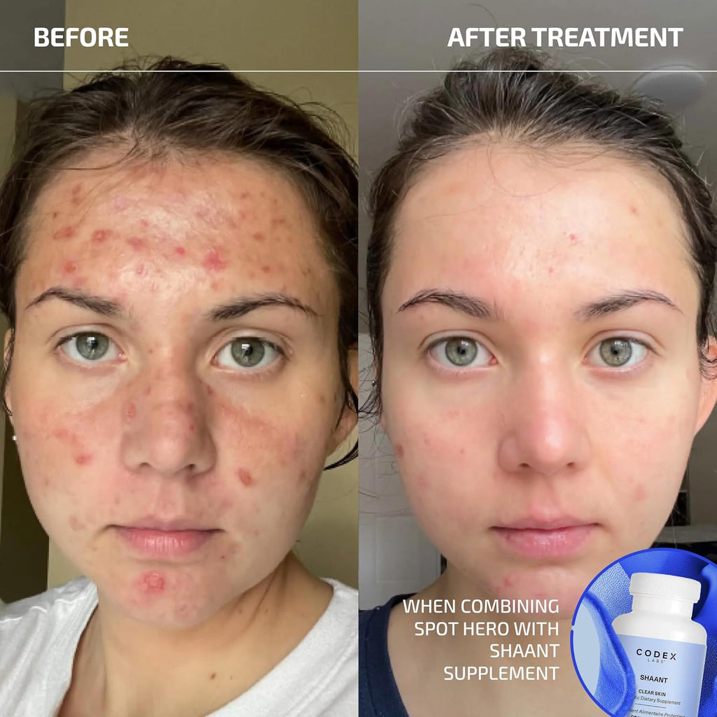 Codex Labs Shaant Spot Hero – Sulfur & Green Tea Gel for Blemish-Prone Skin | Fast-Drying Formula for Clear-Looking Skin | 0.5oz