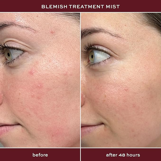 ITK Skincare 2% Salicylic Acid Spray for Face & Body Acne - Blemish-Fighting Treatment for Body Acne, Bacne, Blackheads, Pimples & Blemishes - BHA Blemish Facial Mist Post Workout - 3.3oz Spray Bottle