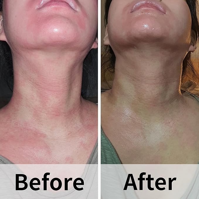 Ato Fast Calming Serum Mother’s Day Gift for Sensitive & Eczema-Prone Skin Instant Relief from Itch, Redness & Flare-Ups Powered by Cica & Panthenol 1.69 Fl Oz