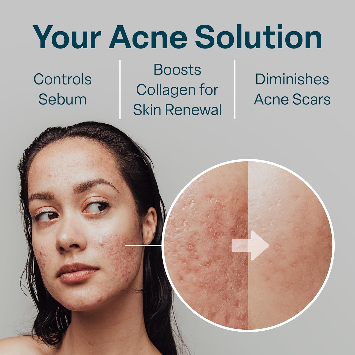 QRxLabs Salicylic & Glycolic Acid Pads (2% Salicylic & 10% Glycolic) - 50 Count Jar - Exfoliating Pads for Acne & Bacne Treatment with Vitamins B5, C & E & Calendula & Green Tea