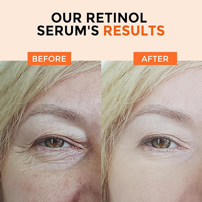 Retinol Serum for Face 2.5%, B5 Resurfacing Retinol Serum with Vitamin C, Vitamin E, Hyaluronic Acid, Niacinamide, Serum for Anti-Aging, Wrinkle Smoothing, Dark Spot Corrector, Brighten Dullness